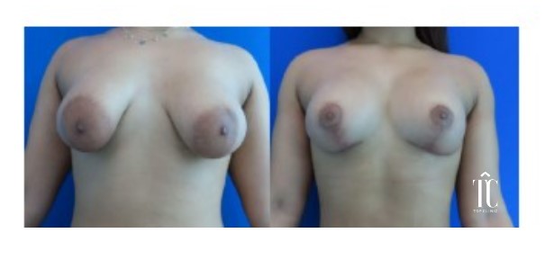 cirugía de pecho antes y después
