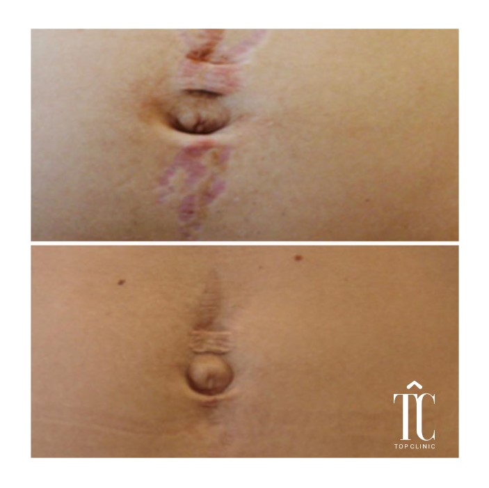 tratamiento cicatrices corporales antes y después