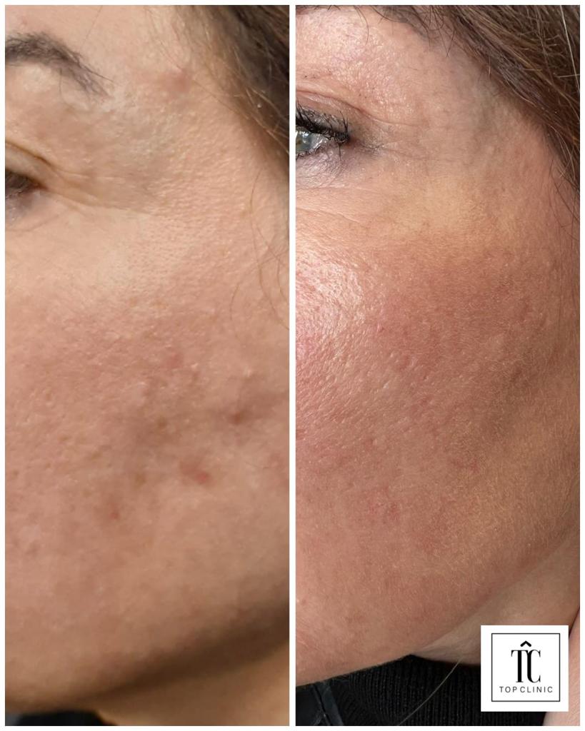 tratamientos acné antes y después