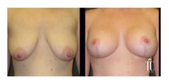 mama tuberosa, operación de pecho antes y después