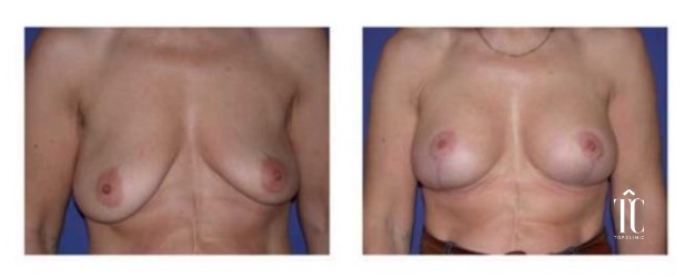 Operación de mamoplastia
